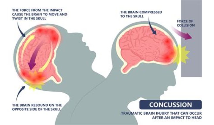 
Did Jaylon Ferguson Die Of Concussion As American Footballers Get A Lot Of Head Trauma? 