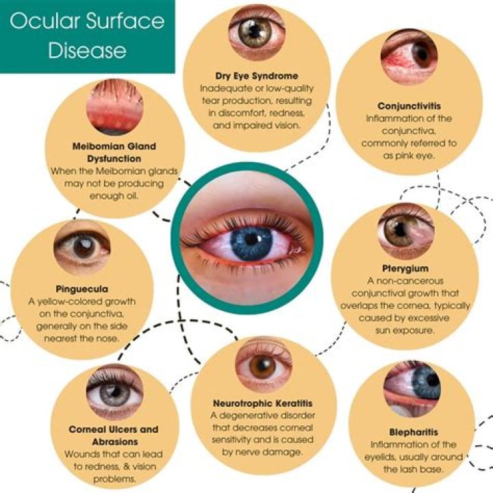 Does Ian Mcshane Have A Glass Eye? Actor Eye Related Injury And Condition Described