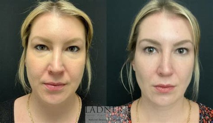 Health Update: Has Hayley Williams Done Plastic Surgery? Before And After Photo