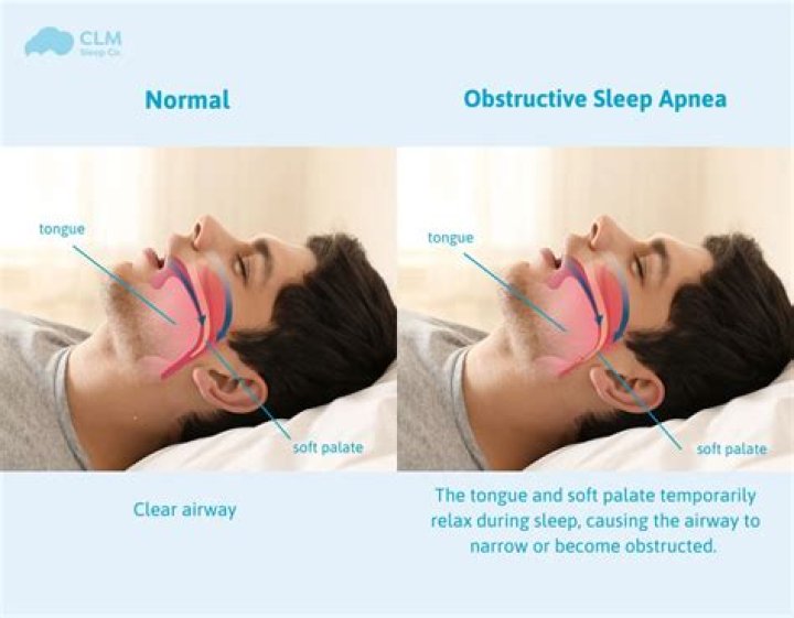 
What Really Happened To Bappi Lahiri Voice? How Is Obstructive Sleep Apnea Caused? 